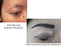 corrective eyebrow transplant