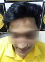 Nother pic of After Surgery Review. Surgery done at face value clinic mumbai.