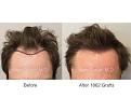 Patient of Dr. Marc Dauer who received 1862 grafts via FUT.