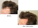 Patient of Dr. Marc Dauer who received 1862 grafts via FUT.