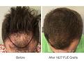 1627 FUE Grafts performed by Dr. Marc Dauer