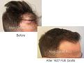 1627 FUE Grafts performed by Dr. Marc Dauer