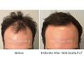 1825 Grafts FUT by Dr. Marc Dauer