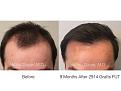 Patient hair transplant result of Dr. Marc Dauer.