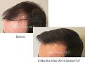 Patient hair transplant result of Dr. Marc Dauer.
