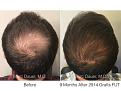 Patient hair transplant result of Dr. Marc Dauer.