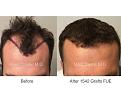 1542 FUE Grafts by Dr. Marc Dauer