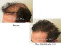 patient hair transplant result of Marc Dauer, MD