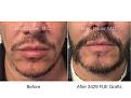 beard FUE hair transplant