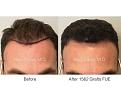1562 grafts FUE performed by Dr. Marc Dauer