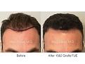 1562 grafts FUE performed by Dr. Marc Dauer