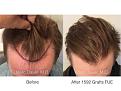 Dr. Marc Dauer hair transplant photos