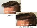 FUE hair transplant by Dr. Marc Dauer