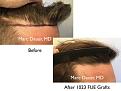 FUE hair transplant by Dr. Marc Dauer