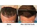 FUE hair transplant by Dr. Marc Dauer