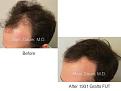 hair transplant photo