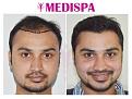 Medispa Hair Transplant Center
Ph : +91-8527220878, +91-8527220815 
Email: info@medispaindia.in