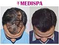 Medispa Hair Transplant Center
Ph : +91-8527220878, +91-8527220815 
Email: info@medispaindia.in