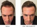 hair transplant patient of Dr. Marc Dauer