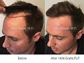hair transplant patient of Dr. Marc Dauer