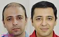 dr suneet soni hair transplant correction beofre after 4500 grafts