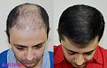 medispa hair transplant repair beofre after 4500 grafts