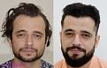 hair transplant usa patient before after 3000 grafts