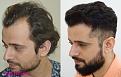 hair transplant usa patient 3000 grafts