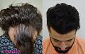 hair transplant us 3000 grafts