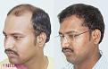 hair restoration india with dr suneet soni 4200 grafts
