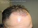 PANINE, MD FUE Hair Transplant Results