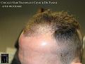 PANINE, MD FUE Hair Transplant Results