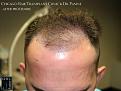 PANINE, MD FUE Hair Transplant Results