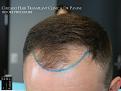 PANINE, MD FUE Hair Transplant Results