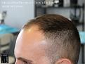 PANINE, MD FUE Hair Transplant Results