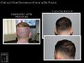 PANINE, MD FUE Hair Transplant Results