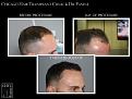 PANINE, MD FUE Hair Transplant Results