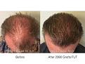Marc Dauer MD hair transplant results