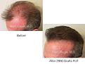 Marc Dauer MD hair transplant results