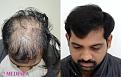 Medispa Hair Transplant Center
Ph : +91-8527220878, +91-8527220815 
Email: info@medispaindia.in