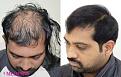 Medispa Hair Transplant Center
Ph : +91-8527220878, +91-8527220815 
Email: info@medispaindia.in