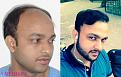 Medispa Hair Transplant Center
Ph : +91-8527220878, +91-8527220815 
Email: info@medispaindia.in