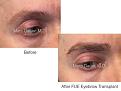 fue eyebrow transplant patient of Dr. Marc Dauer