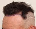 Before FUE