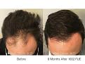FUE results of Dr. Marc Dauer
