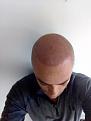 After surgery The Hair Dr Clinic (Dr Arshad)