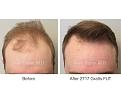 hair transplant patient tof Dr. Marc Dauer