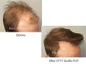 hair transplant patient tof Dr. Marc Dauer