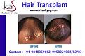 hairtransplant