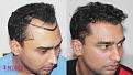 Medispa Hair Transplant Center
Ph : +91-8527220878, +91-8527220815 
Email: info@medispaindia.in